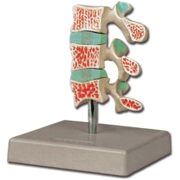 Osteoporozes modelis N1 Santaks